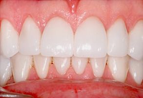 Zen Dentistry | Teeth Whitening, ZOOM Whitening and Porcelain Veneers
