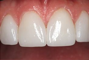 Zen Dentistry | Ceramic Crowns, Preventative Program and Inlays amp Onlays